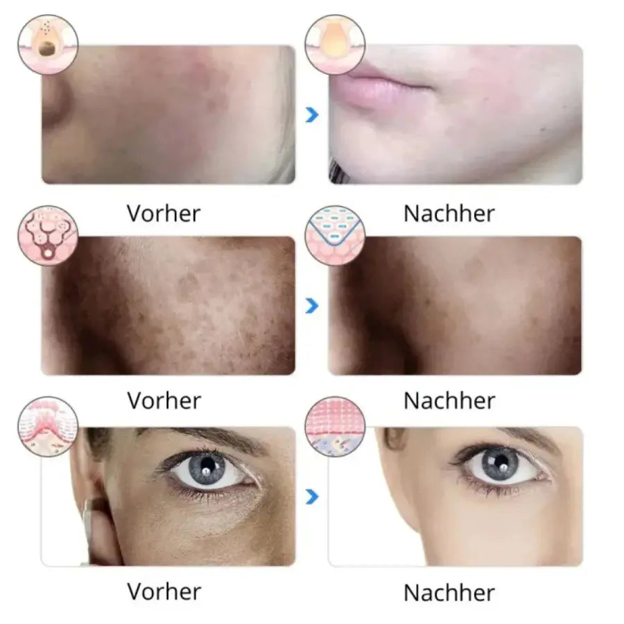VELYRA™ Mascarilla facial terapéutica