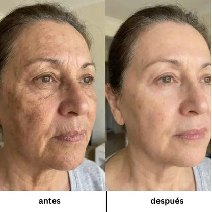 VELYRA™ Mascarilla facial terapéutica